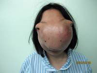 Chinese avatar girl with huge facial tumour